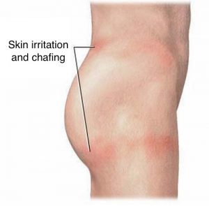 skin irrartion chafing