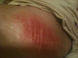 thigh chafing,chafing rash,sweat rash,inner thigh sweat rash,anti chafing,stop chafing,stop thigh chafing,prevent thigh chafing,anti chafing underwear,stop chafing underwear