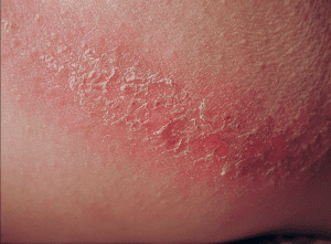 prevent sweat rash Archives » Chaffree