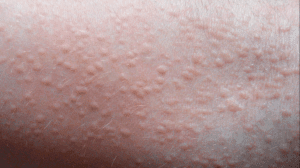 heat sweat rash in groin area