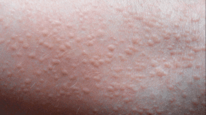 avoid the groin sweat rash by changing your underwear