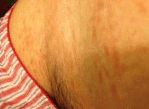 sweat rash groin