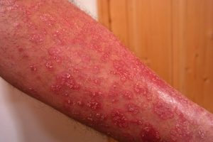 psoriasis relief