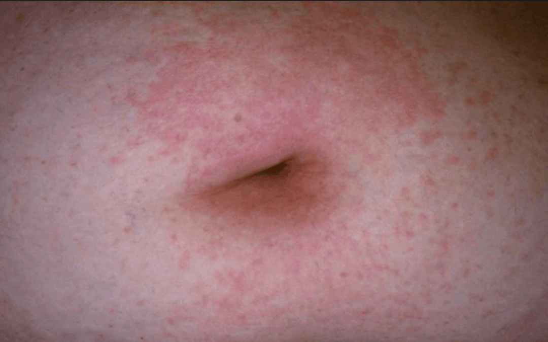 relief from shingles