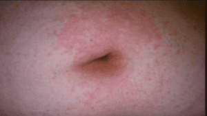 relief from shingles