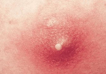 Painful Lump on Thigh  What You Need to Know  How to Treat  Buoy