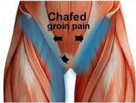 How to stop groin chafing and sweat from becoming a painful problem