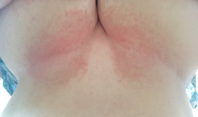 prevent sweat rash Archives » Chaffree